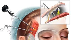 Migraine Surgery