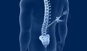 Spine Surgery